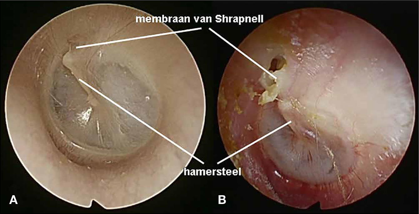 Neurologische presentaties van een cholesteatoom - TNN