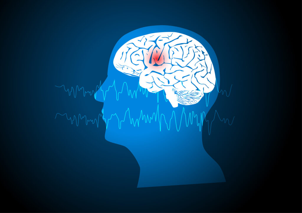 relais Binnenwaarts Optimaal Onderzoek in Maastricht naar radiotherapie als mogelijke behandeling van  focale epilepsie - TNN