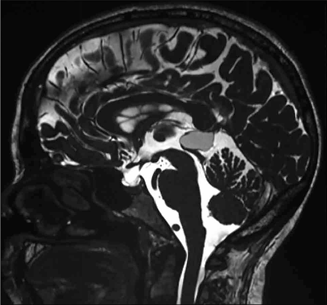 FIGUUR 1. De preoperatieve MRI toonde een glad omschreven cysteuze laesie ter plaatse van de glandula pinealis met een T2 hyperintense inhoud, iets minder intens dan de omliggende liquor, passend bij een pinealiscyste.