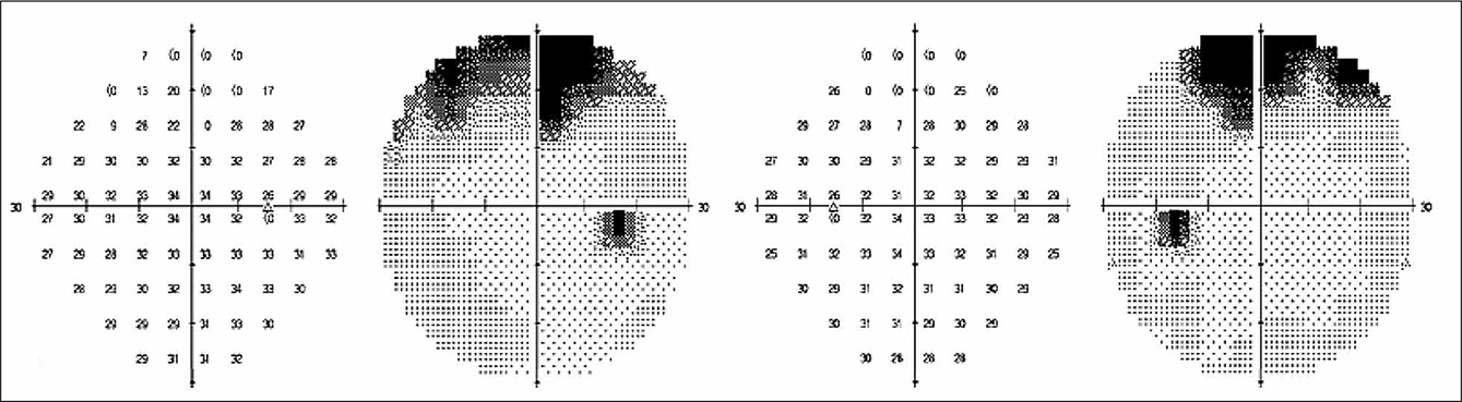 FIGUUR 2. Preoperatief gezichtsveldonderzoek toonde een defect van de bovenste kwadranten.