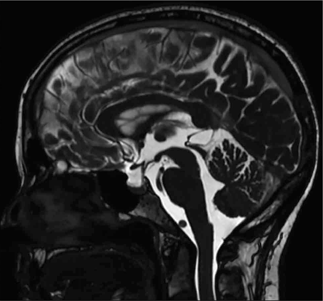 FIGUUR 4. Na microchirurgische fenestratie was de diameter van de cyste afgenomen, waarbij de inhoud iso-intens was aan de liquor.